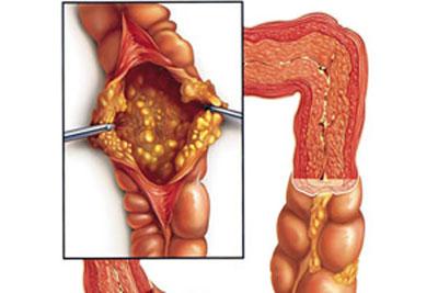 Псевдомембранный колит
