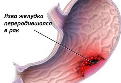 Возникновение рака желудка