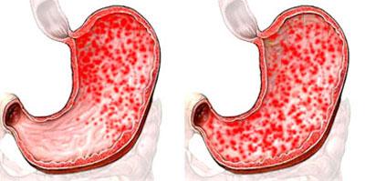 Эрозивный гастрит