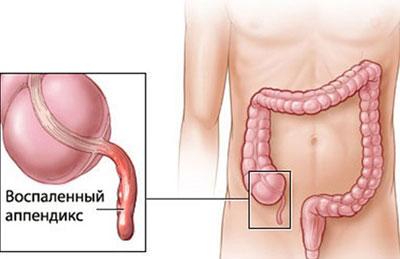 Воспаление аппендикса