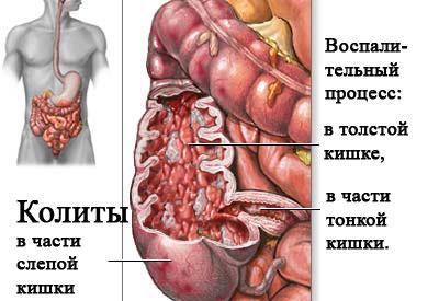 Проявление колита