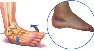 Растяжение связки