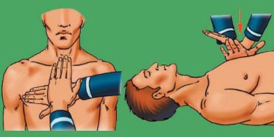 Массаж сердца