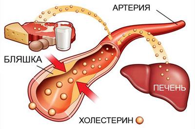 Отложение холестерина