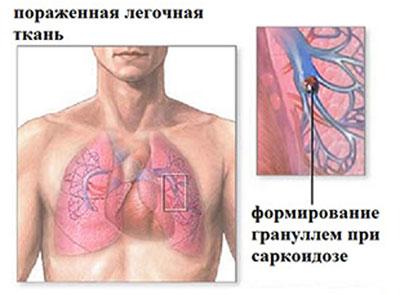 Легкие при саркоидозе