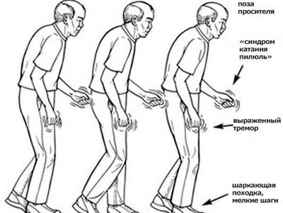 Симптомы болезни Паркинсона