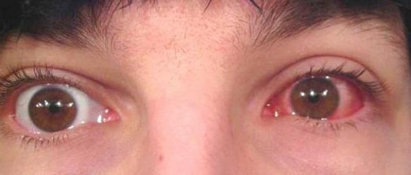 симптомы красных глаз