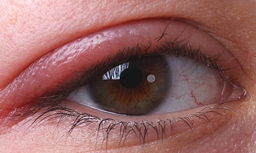 симптомы блефарита