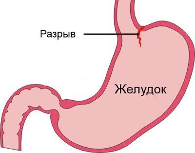 Синдром Мэлори-Вейса