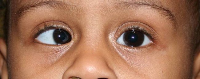 косоглазие