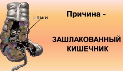 Шлаки в кишечнике