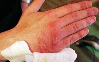 Ожог кожи от борщевика