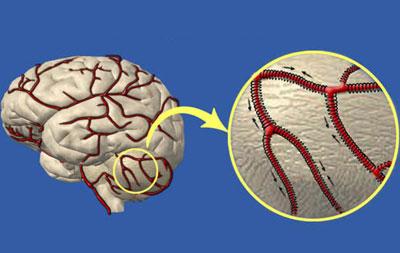 Сосуды головного мозга