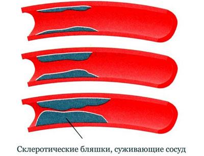 Развитие атеросклероза