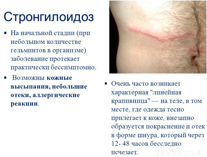 стронгилоидоз.jpg