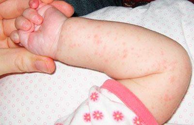 Сыпь у ребенка
