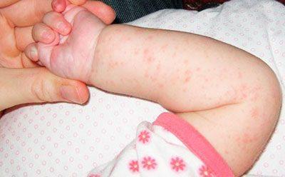 Сыпь у ребенка