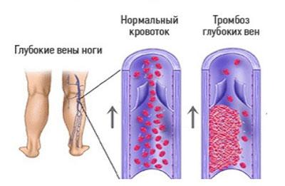 Проявление тромбоза