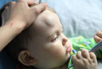 Шишка на голове ребенка