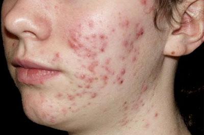 Угревая сыпь
