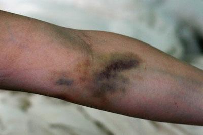 Синяк после капельницы