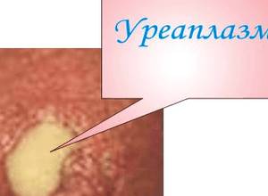 ureaplazmoz-pri-beremennosti-slabye-simptomy_2.png