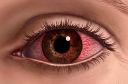 лечение увеита