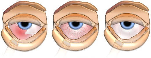 увеит глаза