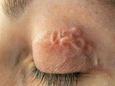 черви в глазах