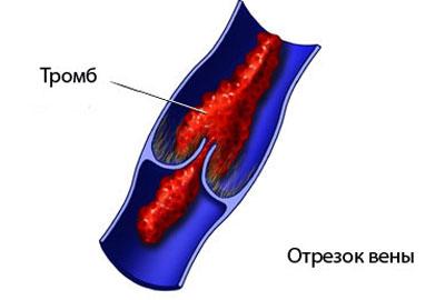 Образование тромба