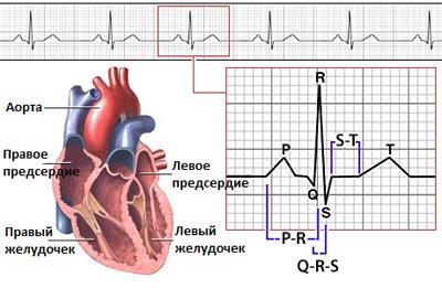 Вычисление аритмии