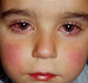 конъюнктивит у ребенка