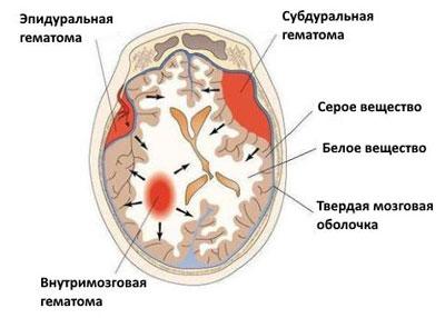 Кровоизлияние в мозг