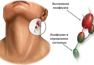 Воспаление лимфоузла