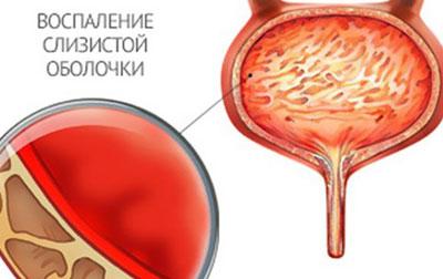 Воспаление мочевого пузыря