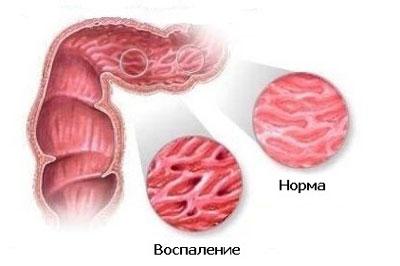 Воспаление слизистой кишечника