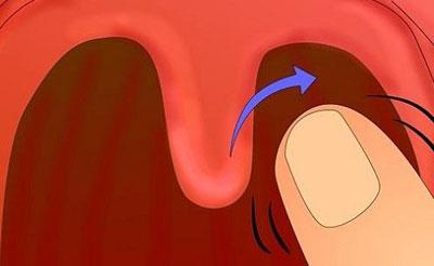 Вызов рвоты