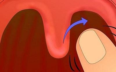Вызов рвоты