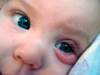 у детей воспаление глаз