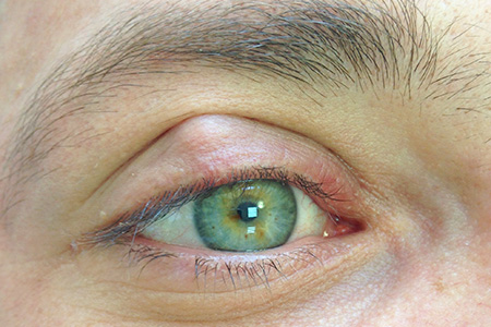 причины халязиона