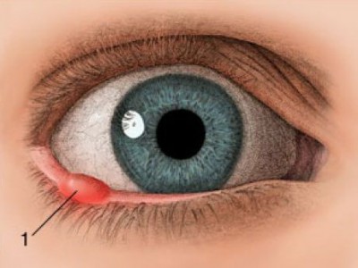 причины чирья на глазу