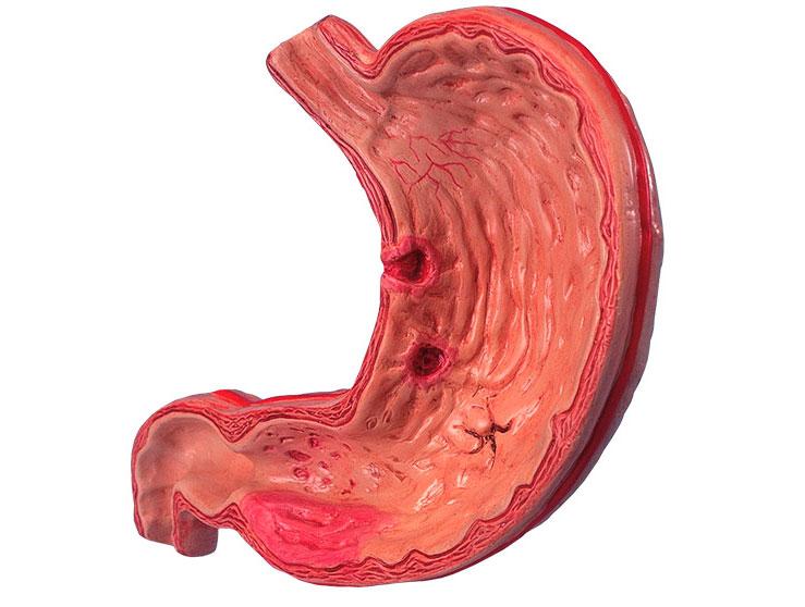 Обострившаяся язва