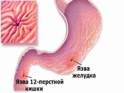 Язвенная болезнь