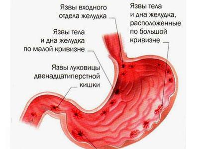 Язвенная болезнь