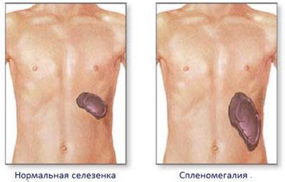 Увеличенная селезенка