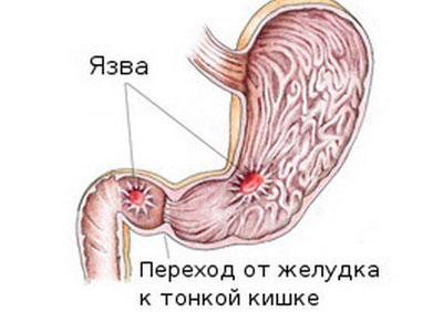 Язвенная болезнь