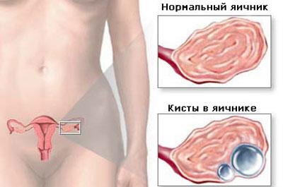 Кисты в яичнике