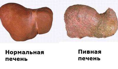 Пивная печень