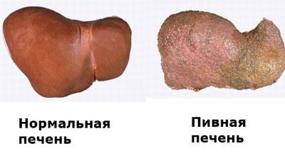 Влияние алкоголя на печень